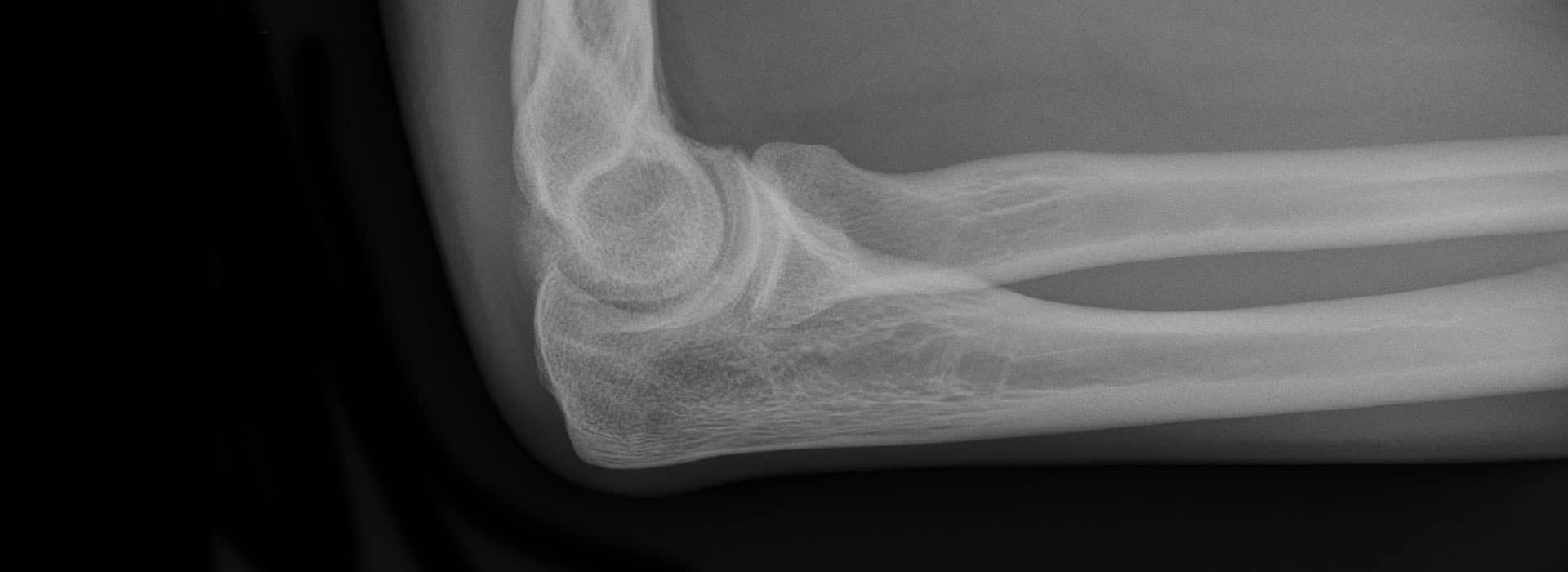 Acromioclavicular Joint Arthritis Dr Paul Jarrett Orthopaedic Images