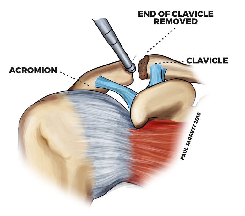 Acromioclavicular-joint-excision-1.jpg