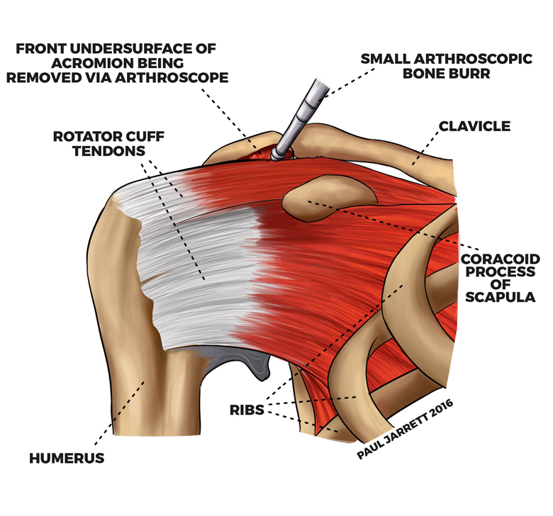 Rotator Cuff Injury/Subacromial Bursitis - Injuries and Poisoning
