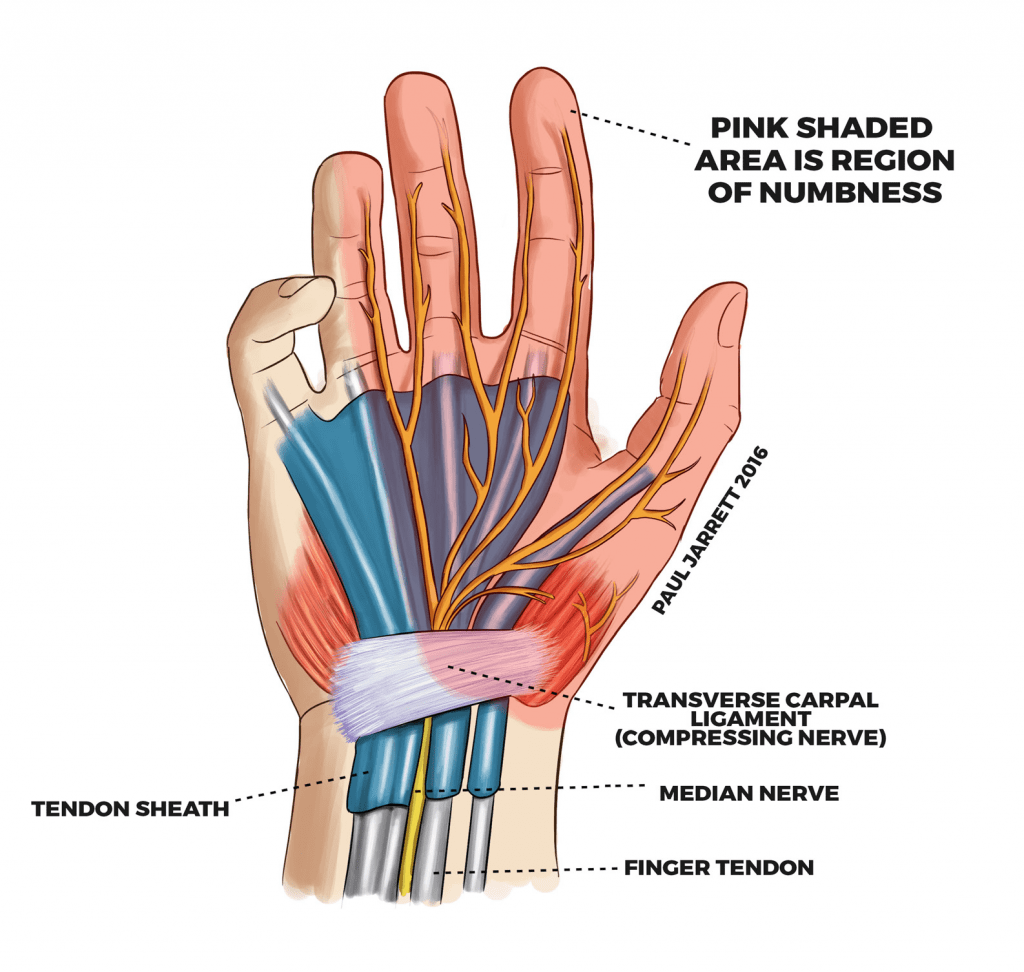 Carpal Tunnel Syndrome Diagram