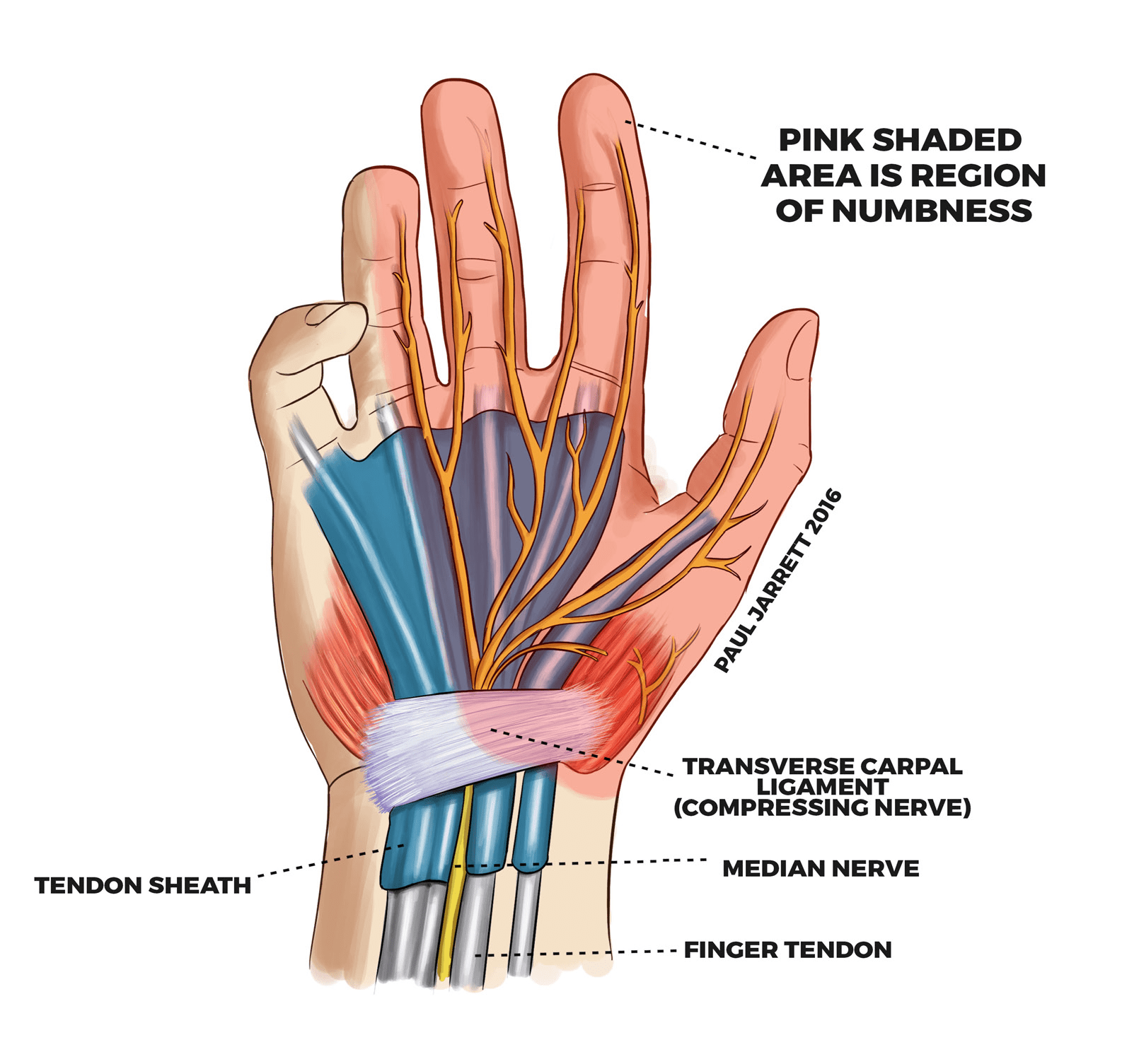 Carpal Tunnel | Dr Paul Jarrett, Hand, Wrist & Shoulder Surgeon. Perth.