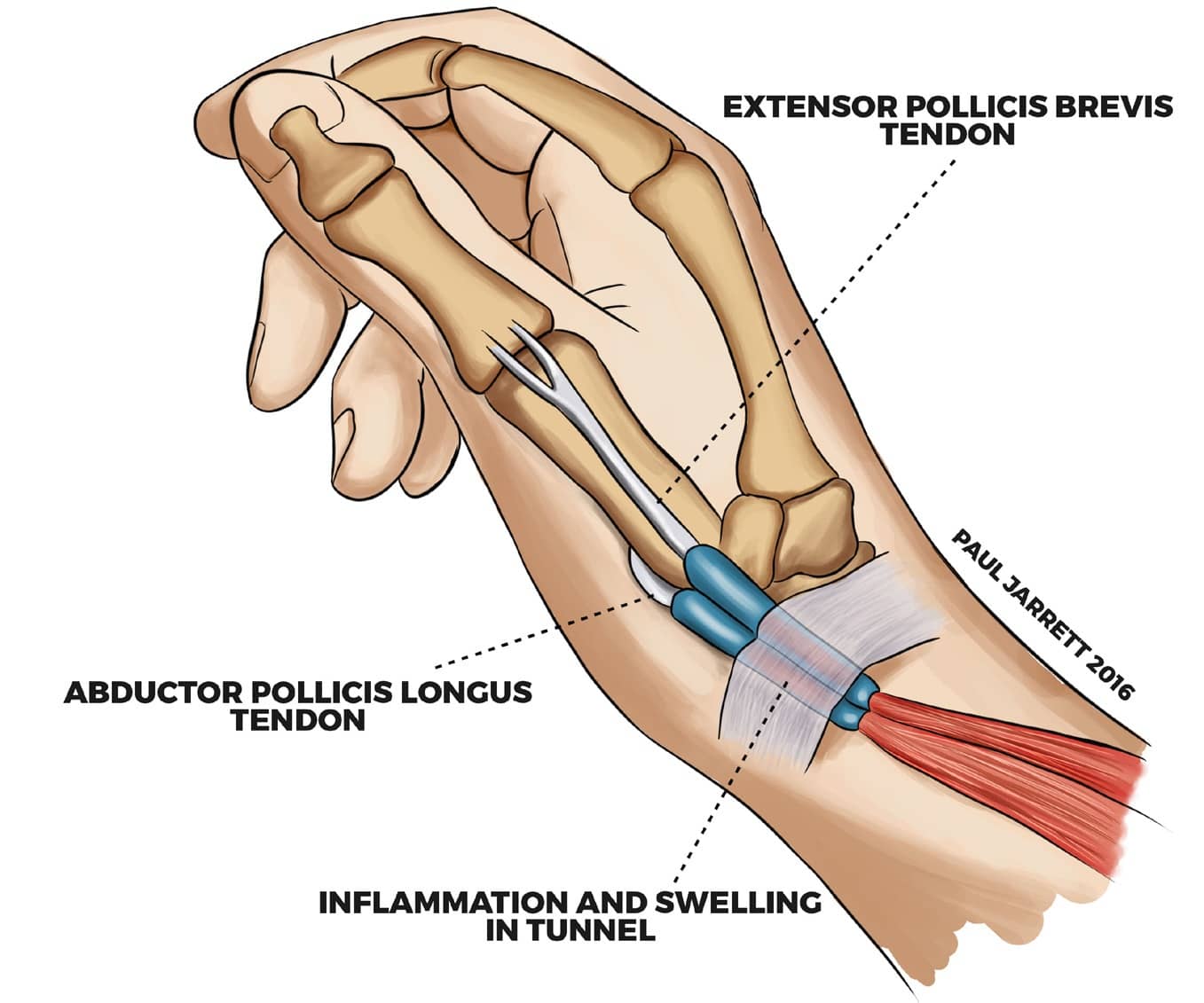 dequervain-s-tenosynovitis-dr-paul-jarrett