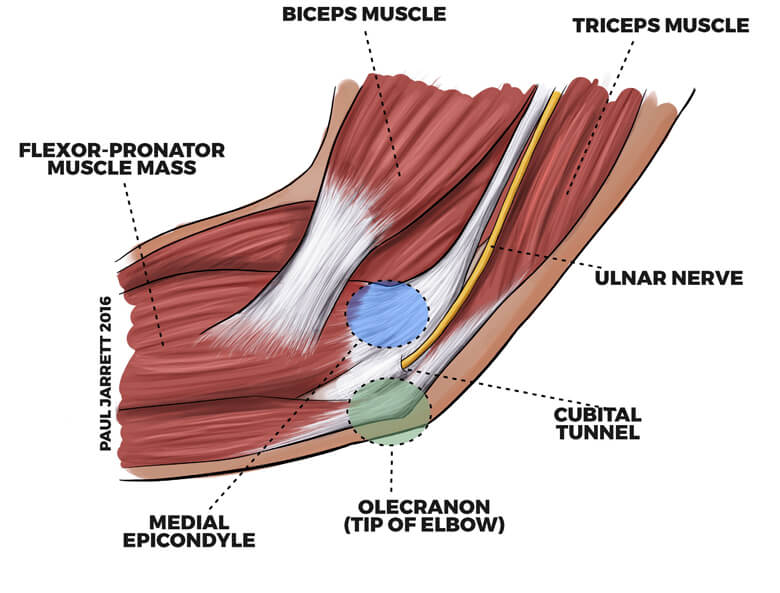 Diagram explaining cubital tunnel syndrome