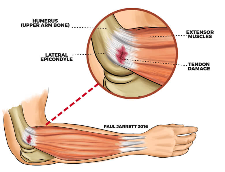 tennis elbow injection