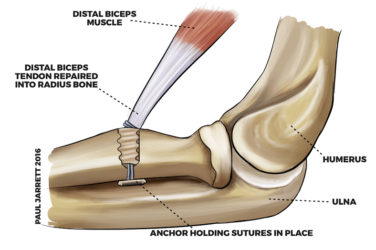 Graphic illustration showing a Distal Biceps Tendon Repair