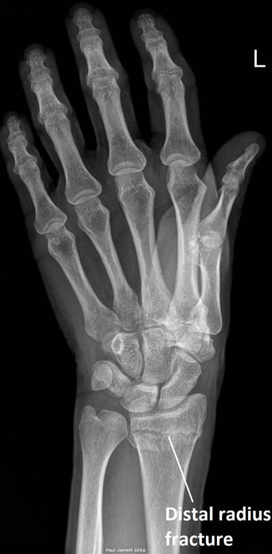 Distal Radial Fracture Xray