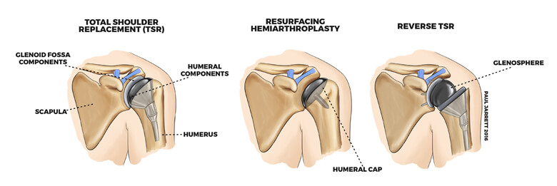 Diagrams showing total shoulder replacement and other shoulder treatment options.