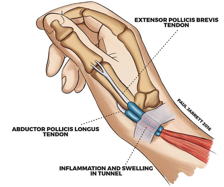 Dequervain S Tenosynovitis Hand Wrist Surgeon Perth