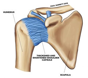 Adhesive Capsulitis - Dr Paul Jarrett, Shoudler Specilaist Perth