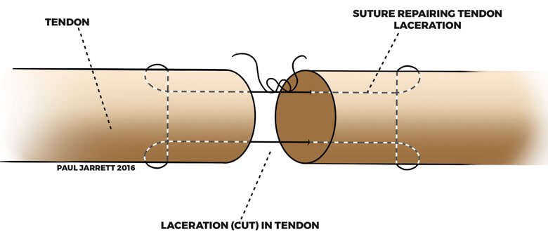 Diagram depicting elbow laceration