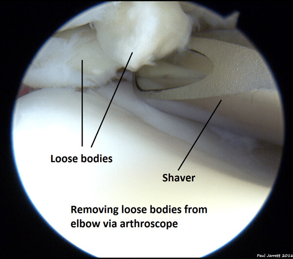 Photo of loose bodies being removed arthroscopically in the elbow