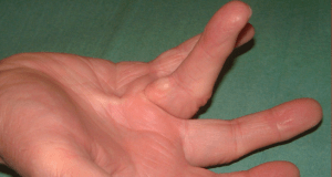 Dupuytren's Contracture Photo