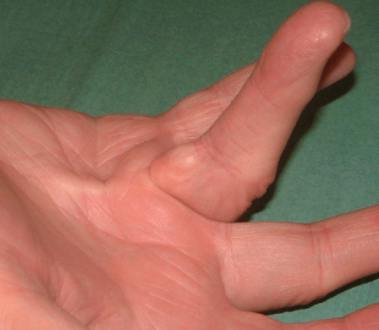 Dupuytren's Contracture Photo of hand