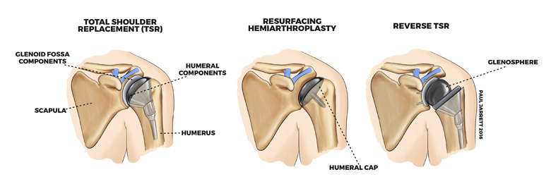 Diagram explaining shoulder arthritis
