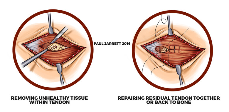 Graphic Showing Tennis Elbow Repair